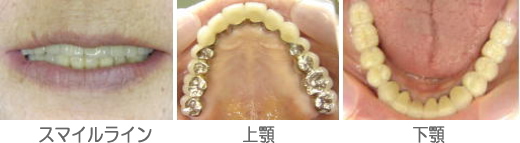 多数歯欠損症例治療後
